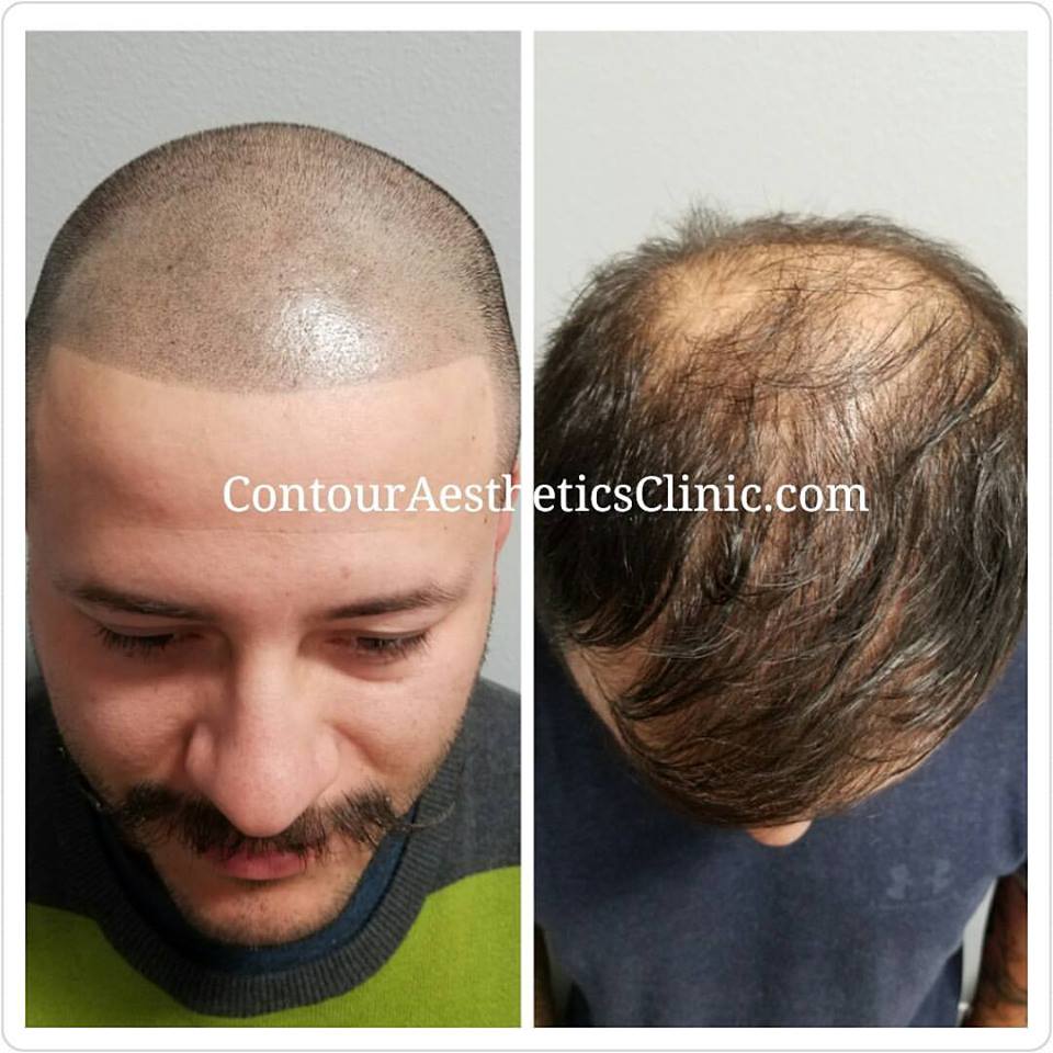 tampa bay fl scalp micropigmentation