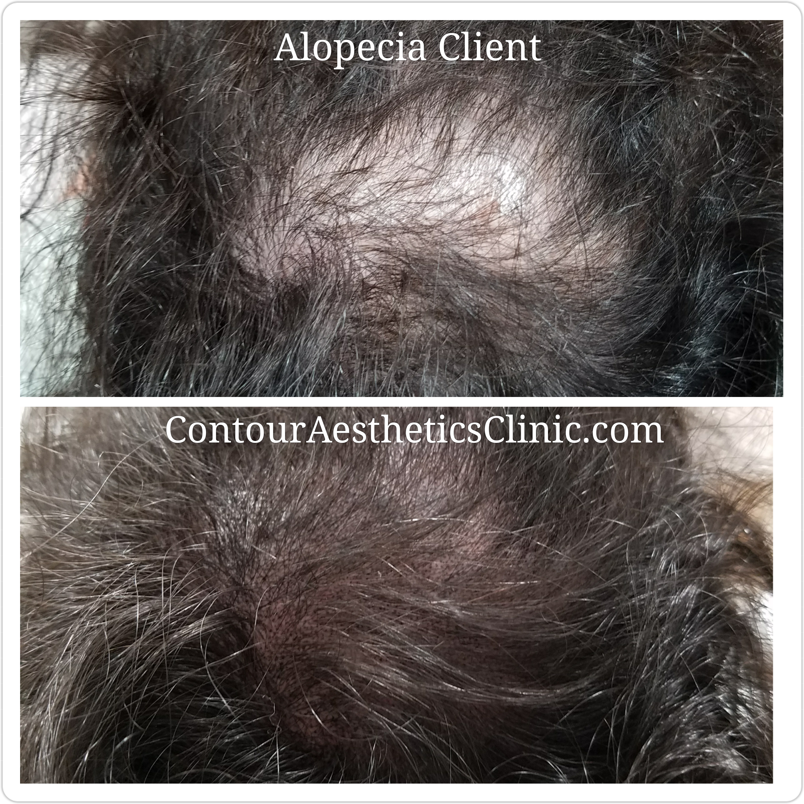 female scalp micropigmentation tampa fl